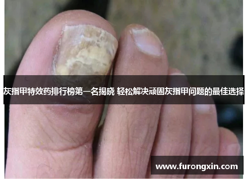 灰指甲特效药排行榜第一名揭晓 轻松解决顽固灰指甲问题的最佳选择